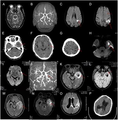 Case report: Meningitis and intracranial aneurysm caused by mixed infection of oral microflora dominated by anaerobes